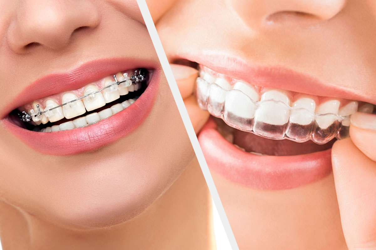 Types Of Materials Used In Braces - Clover Smile Studio